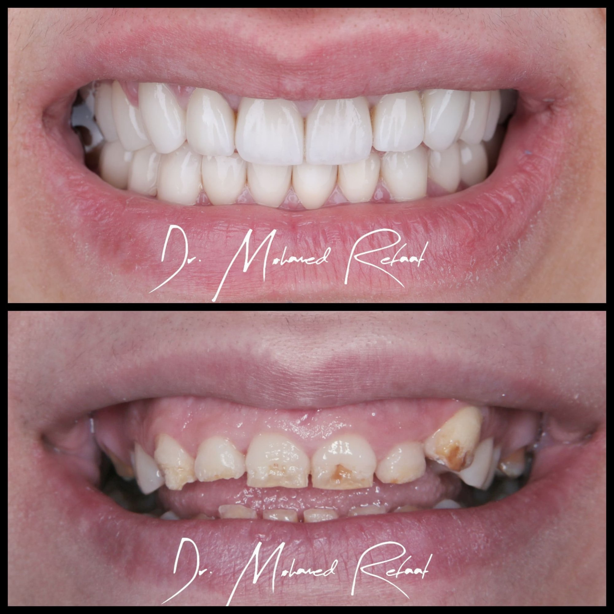 Smile makeover