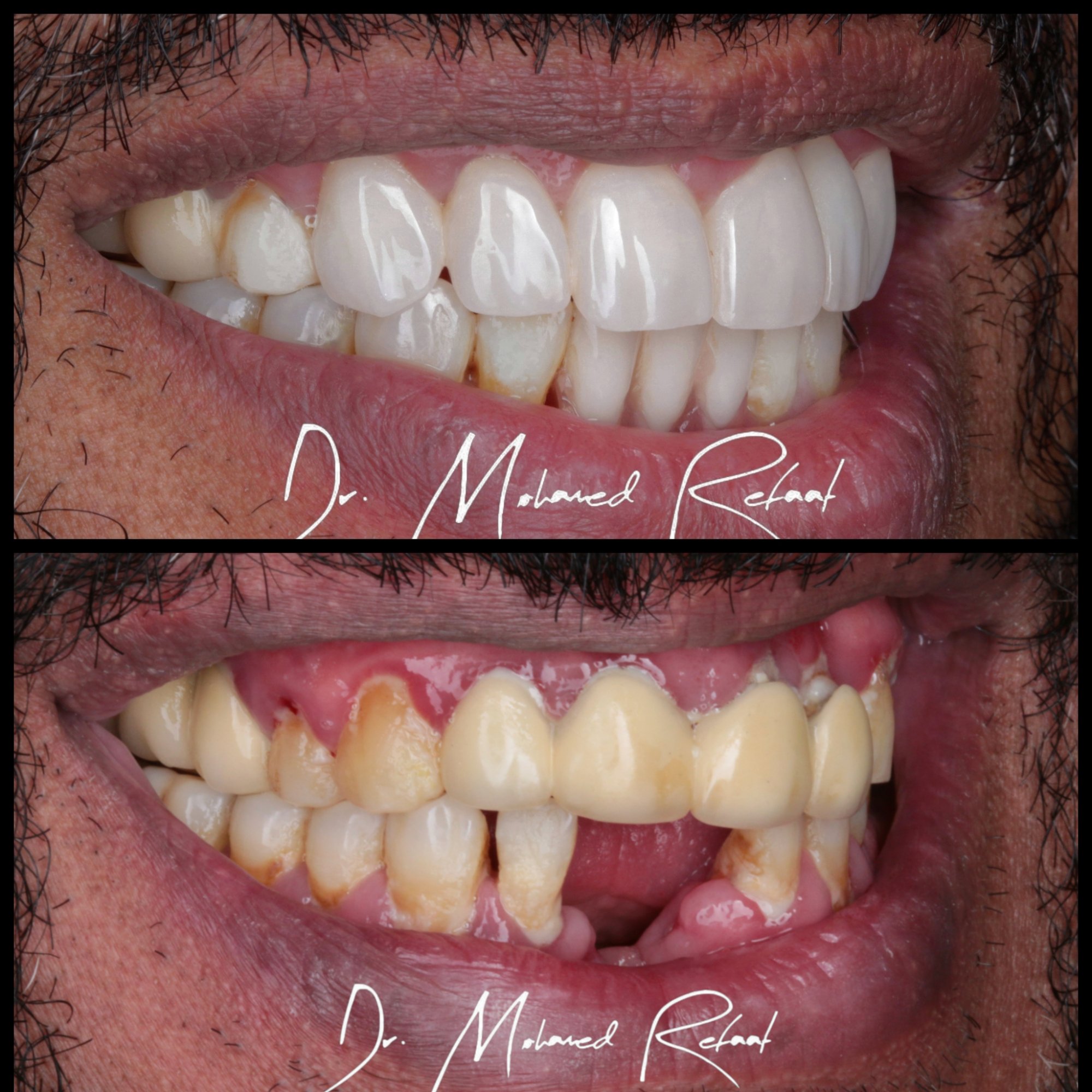 Zirconia crowns